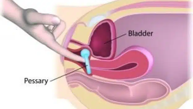 Natural Solutions for Abdominal Organ Prolapse